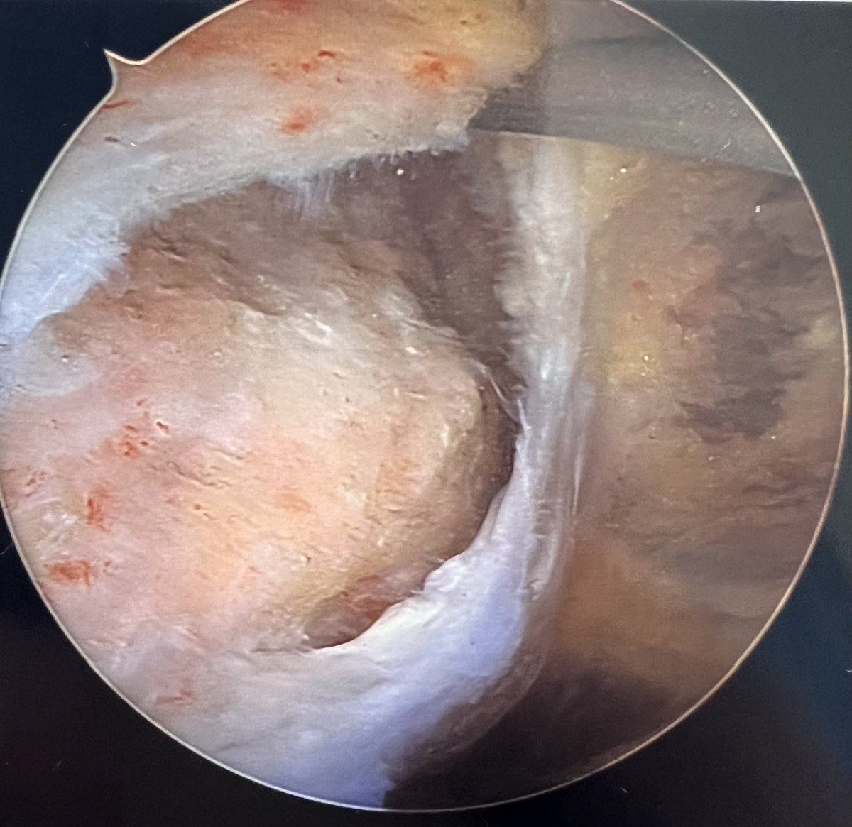 SSittonMD's tweet photo. Yep, it’s torn. iykyk🤪 #orthotwitter #ButtCuff https://t.co/G2l60jY9Kl