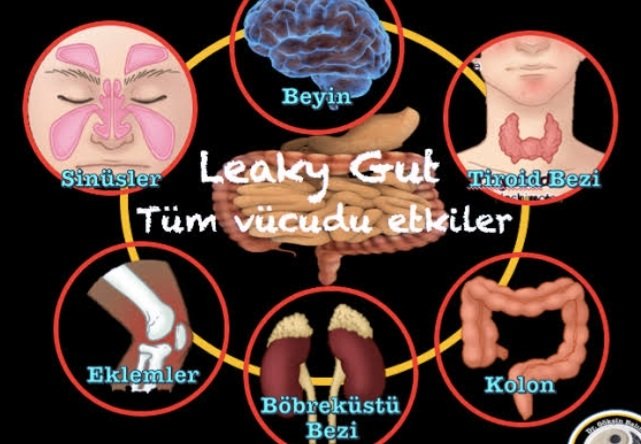 🔴AŞIRI GEÇİRGEN BAĞIRSAK (Leaky gut) 🟣ÇOK ÖNEMLİ,sıkılmadan okuyabileceginiz ve kendinizden bir parça bulacağınız durum 🔵Bir çok hastalikta etken..TOKSİNLER ●Egzema ●IBS ●Sedef ●Sivilce ●krcgr yağlanması ●Kronik halsizlik ●HAŞİMATO ●Kilo verememe ●Beyin sisi ●RA