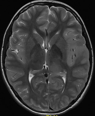 drmankad's tweet image. Tip of the day 💡: In children, high-grade diffuse tumors need not show contrast enhancement, or even frankly restricted diffusion. Be extremely wary of these facts, as these cases are often erroneously labeled 'encephalitis' for a long time before the correct diagnosis is made.