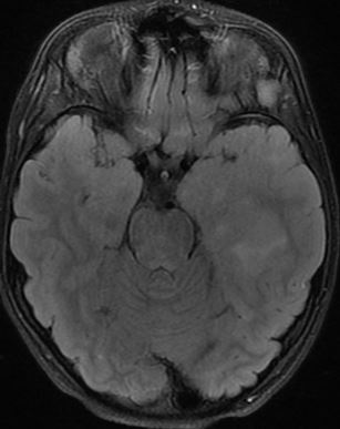 drmankad's tweet image. Tip of the day 💡: In children, high-grade diffuse tumors need not show contrast enhancement, or even frankly restricted diffusion. Be extremely wary of these facts, as these cases are often erroneously labeled 'encephalitis' for a long time before the correct diagnosis is made.