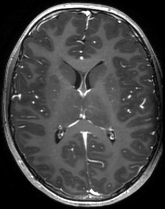 drmankad's tweet image. Tip of the day 💡: In children, high-grade diffuse tumors need not show contrast enhancement, or even frankly restricted diffusion. Be extremely wary of these facts, as these cases are often erroneously labeled 'encephalitis' for a long time before the correct diagnosis is made.