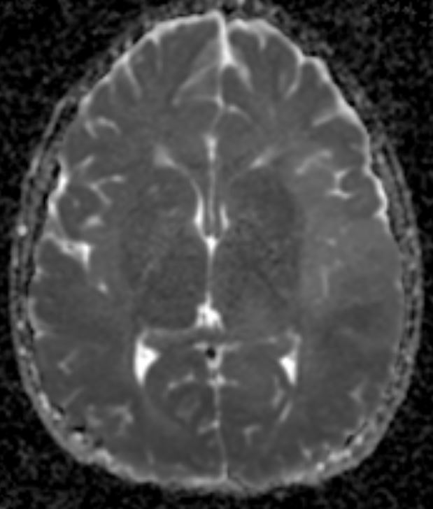 drmankad's tweet image. Tip of the day 💡: In children, high-grade diffuse tumors need not show contrast enhancement, or even frankly restricted diffusion. Be extremely wary of these facts, as these cases are often erroneously labeled 'encephalitis' for a long time before the correct diagnosis is made.