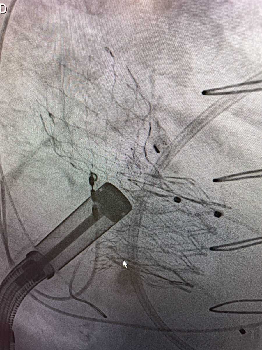 GuiAttizzaniMD's tweet photo. Excellent way to start the week @UHhospitals with a successful transeptal #TMVR as part of the MAC cohort of the APOLLO trial led by my teammates @ACUkaigweMD and @DocCbaezap. Great images by @danieljwyler and pristine results. 
@shishem @DanSimonMD https://t.co/ighTmPz3gb