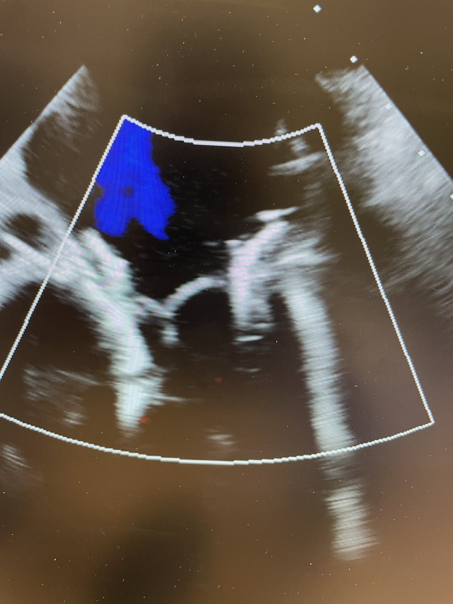 GuiAttizzaniMD's tweet photo. Excellent way to start the week @UHhospitals with a successful transeptal #TMVR as part of the MAC cohort of the APOLLO trial led by my teammates @ACUkaigweMD and @DocCbaezap. Great images by @danieljwyler and pristine results. 
@shishem @DanSimonMD https://t.co/ighTmPz3gb