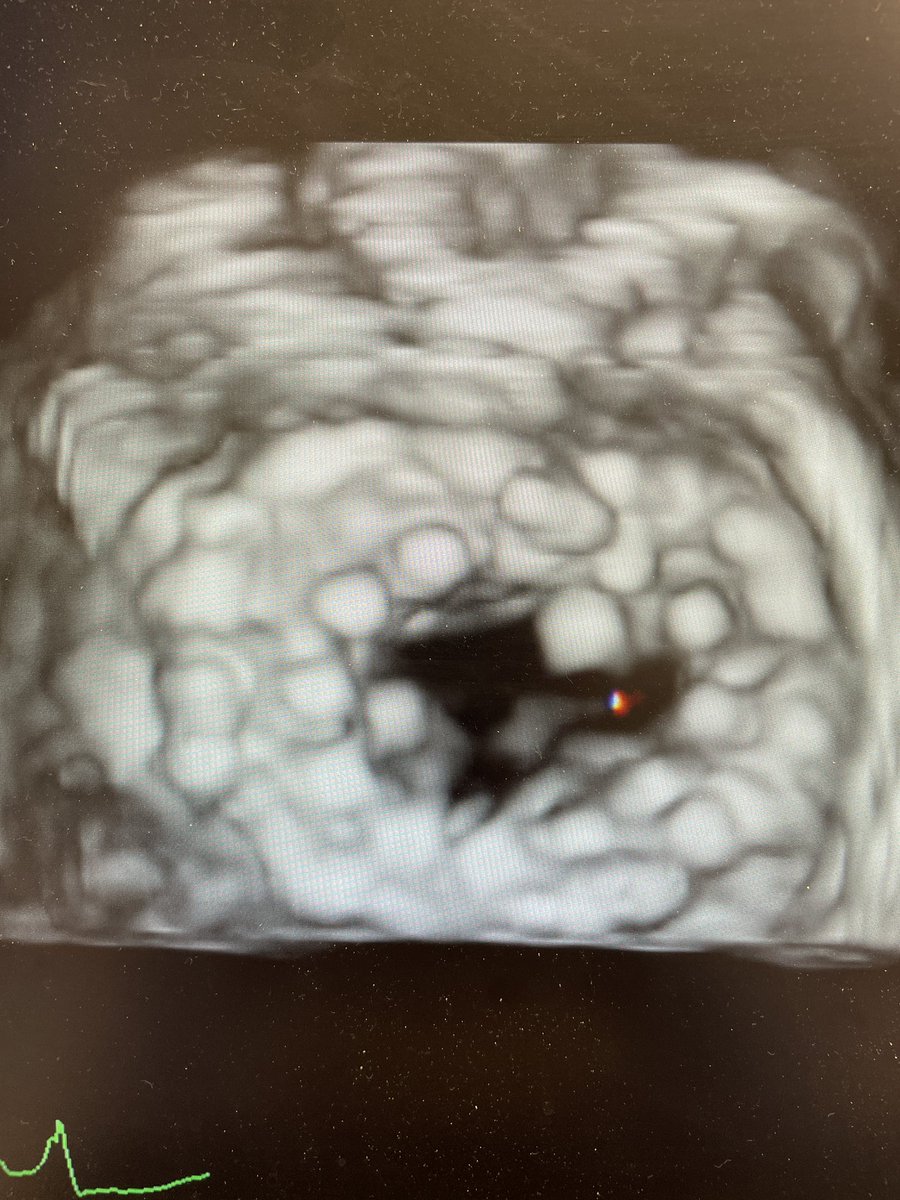 GuiAttizzaniMD's tweet photo. Excellent way to start the week @UHhospitals with a successful transeptal #TMVR as part of the MAC cohort of the APOLLO trial led by my teammates @ACUkaigweMD and @DocCbaezap. Great images by @danieljwyler and pristine results. 
@shishem @DanSimonMD https://t.co/ighTmPz3gb