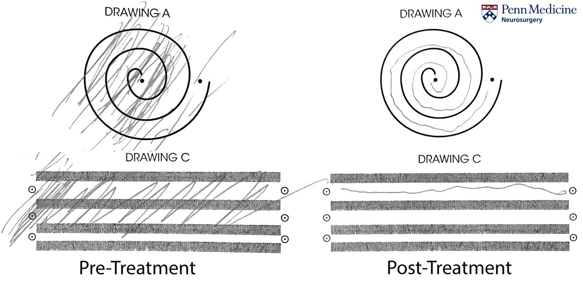 #MRI guided focused #ultrasound (#MRgFUS) can be an effective therapy for essential #tremor.  Patient is awake during the treatment & tested during the process to ensure safety. Here is example of a recent patient treated at @PennMedicine @PennNSG  @CaseyHalpern5 #Neurosurgery