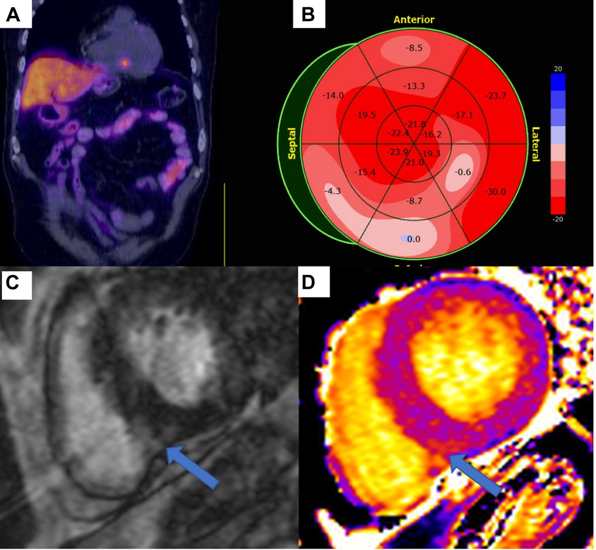 72-year-old man with a stage IV small intestinal neuroendocrine tumor with an abnormal PET and CMR showing carcinoid heart disease. bit.ly/3VYlP4k

#JACCCaseReports #cvPET #whyCMR #CardioTwitter #CardioOnc #CardioOncology