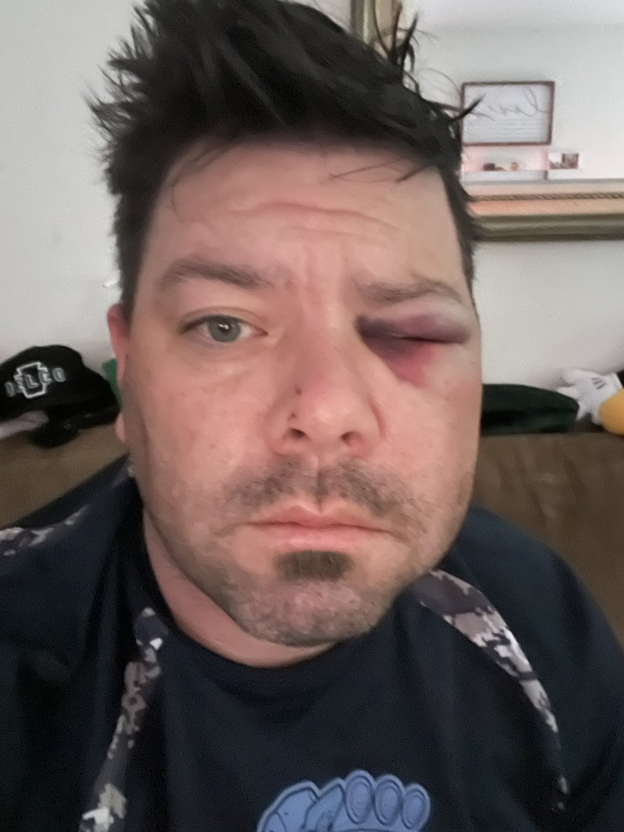 hooknceilin's tweet photo. Had to watch the @Phillies from the hospital yesterday after getting a ball to the face. @bryceharper3 @alecbohm and @rhyshoskins I know now how yous felt. https://t.co/VG2KkCv8cs