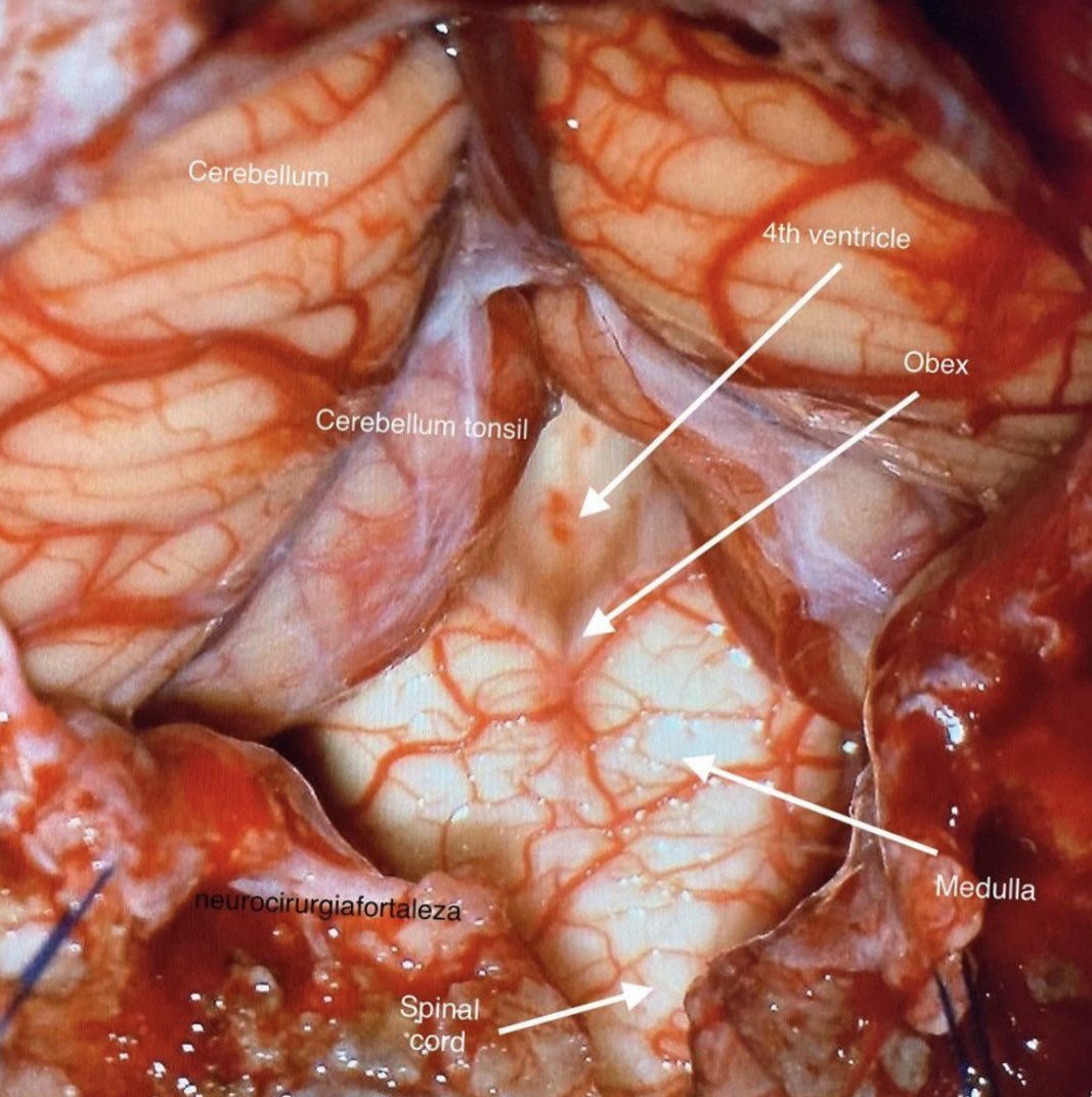 OGdukeneurosurg's tweet photo. Great labeled posterior fossa anatomy. You even get to see the 4th ventricle. Source; Lucas Alverne Albuquerque https://t.co/kiXyIAGfFI