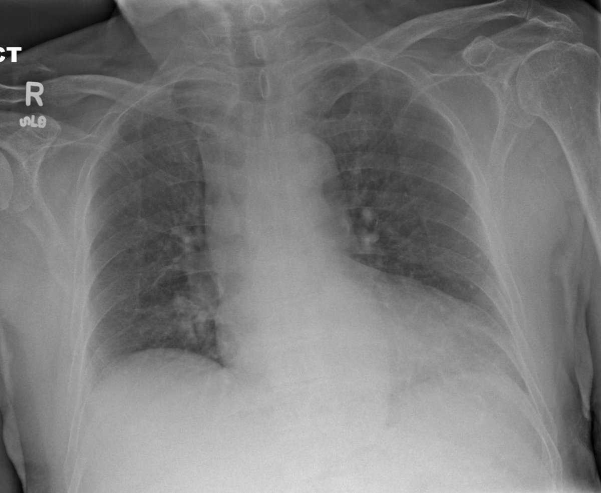 It's time for this week's radiology image challenge question! 45-year-old male presenting with shortness of breath and dry cough. What is the main abnormality? facebook.com/photo.php?fbid…