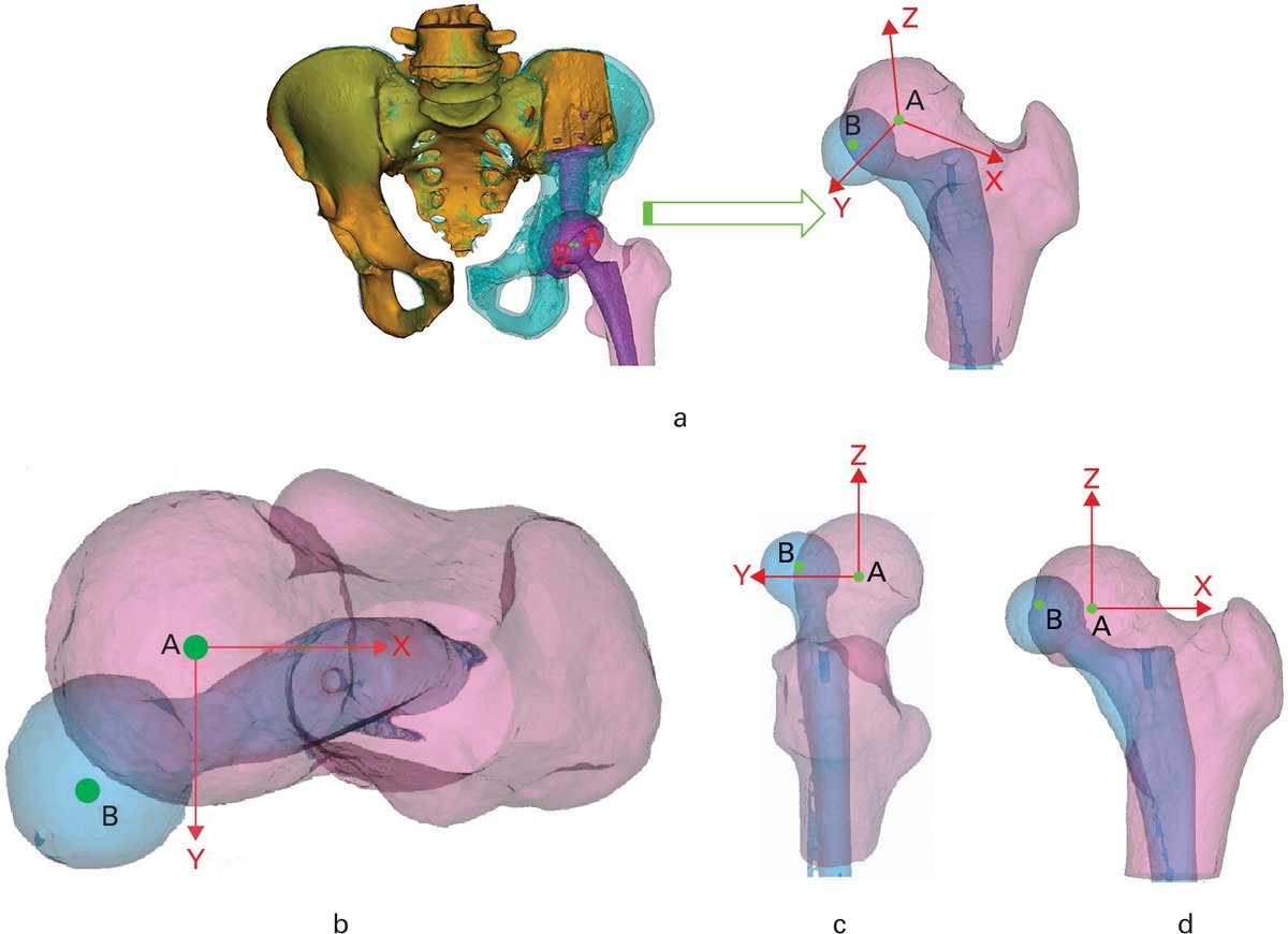 BoneJointJ's tweet photo. The risk factors for dislocation in patients undergoing endoprosthetic reconstruction following periacetabular tumour resection are poorly studied.
#HipDislocation #Oncology #BJJ
https://t.co/q30POHhOQa https://t.co/3lnJmGDgaZ