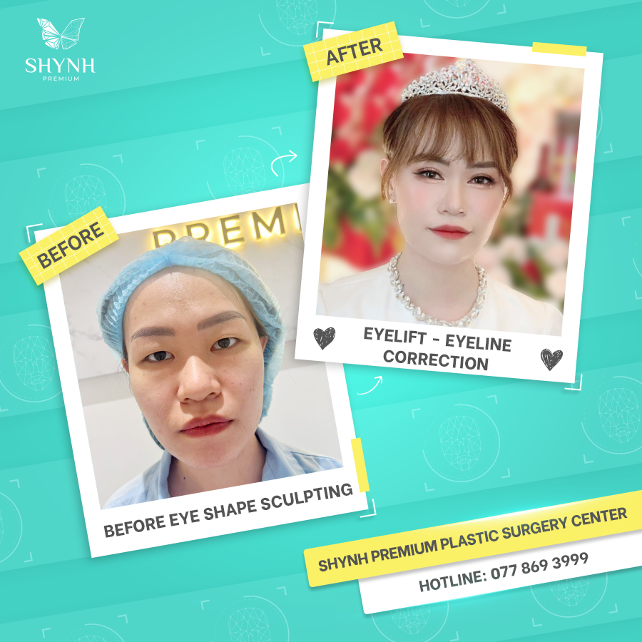 PShynh's tweet photo. ✨BECOME THE BEAUTY GIRL ON THE WEDDING DAY
Nice feedback from customers who performed eyelid surgery and eye-line correction. Your face is completely different, younger, eyes become more luxurious, extremely impressive and suitable for you. https://t.co/KVlA2BTXCL