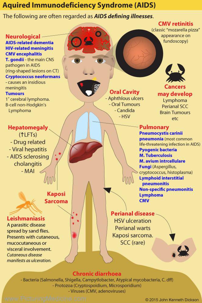 CourageCare's tweet photo. Ang mga infections sa pic are #AIDS defining at rare sa HIV-. Meaning pagmeron nito naaalerto ang Doc sa possibility ng #HIV infection at <200 na #cd4.
Kaya get tested para maaga maagapan at wag matakot HIV doesn't diminish your worth as a person. Free testing  09177088733 https://t.co/nNZPqGxDZ3