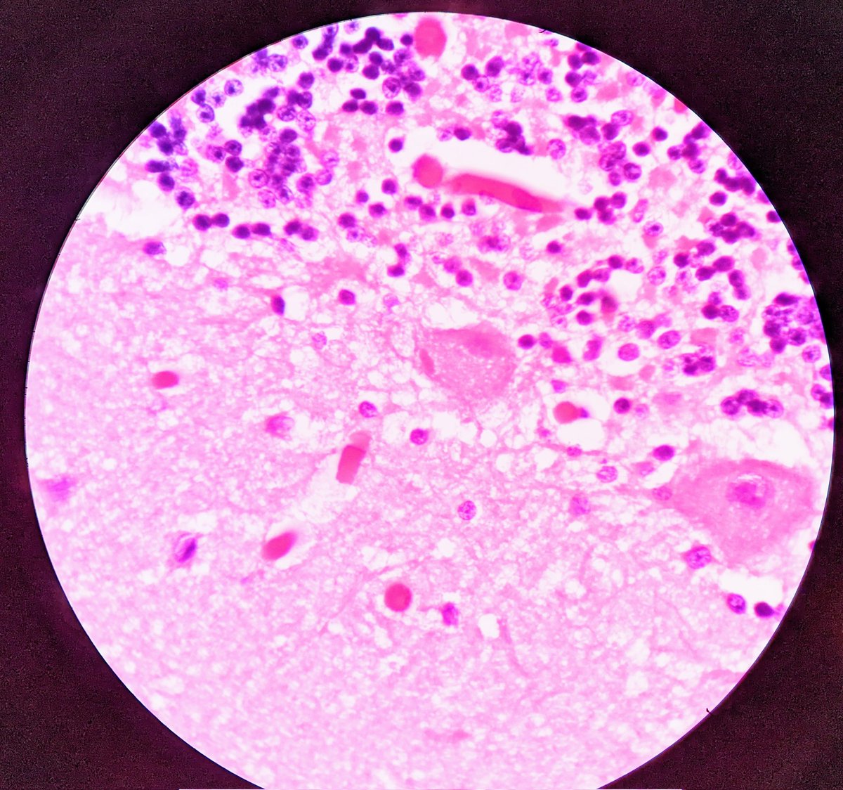 34/M presenting with photophobia, delirium and hydrophobia. With a non reliable history of dog bite. Later confirmed with rabies. Demonstrated Negri bodies on autopsy in purkinje fibres of cerebellum.
#pathology #negribodies