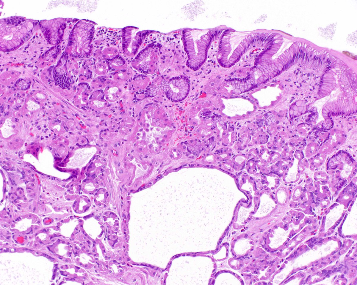 More extraordinary things in ordinary cases.  This fundic gland polyp shows the characteristic "green stuff" (arrow in the low magnification image) in the cystically dilated glands.