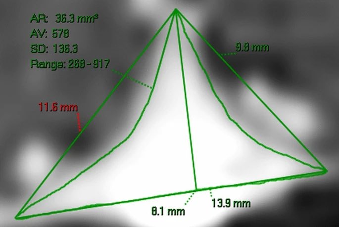 Modelling of the dilated sagittal sinuses found in #MultipleSclerosis  suggests venous #drainage impairment. Venous wall stiffness coupled with moderate increased venous pressure play a role nature.com/articles/s4159…