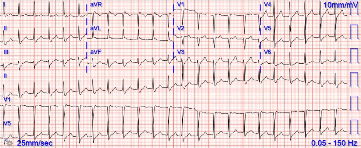 Back to basics: what is this rhythm? What are your options for treating this patient? hqmeded-ecg.blogspot.com/2022/10/back-t…