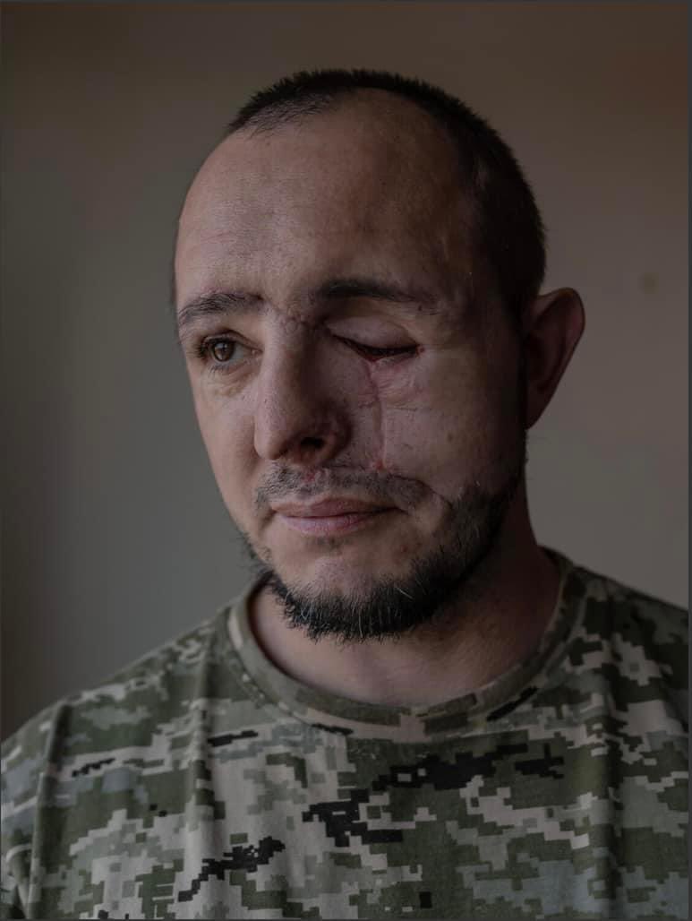 BackAndAlive's tweet photo. Роман Белінський — воїн 14-ої бригади ЗСУ, важко поранений у танковому бою на Запоріжжі. 

Він став одним із пацієнтів американсько-української хірургічної місії в Івано-Франківській лікарні.

Читайте історію героя на Reporters ⟶ https://t.co/DNTGM4rXwp
 
Фото: Данило Павлов https://t.co/qloSvidq9B
