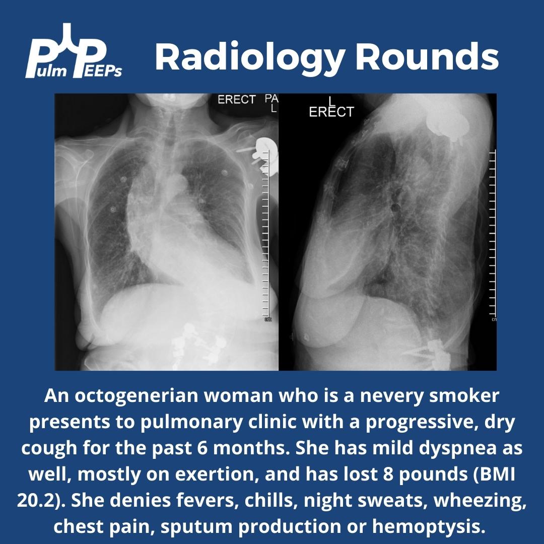 PulmPEEPs's tweet photo. We have a #RadiologyRounds from the pulmonary clinic this week! 🫁

A woman in her 80s presents to the clinic with a progressive, dry cough. She has had some associated dyspnea and weight loss. Here is her chest X-ray 🩻 https://t.co/tSsGT6Cgif