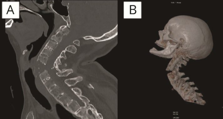 🚨 🚨 Ojo con los amantes y defensores de la quiropraxia

Que no te pase a ti o a tus pacientes lo que le sucedió a esta mujer de 48 años que consultó por dolor cervical crónico, le realizaron quiropraxia y durante la sesión tuvo empeoramiento del dolor cervical y tetraplejia
👇