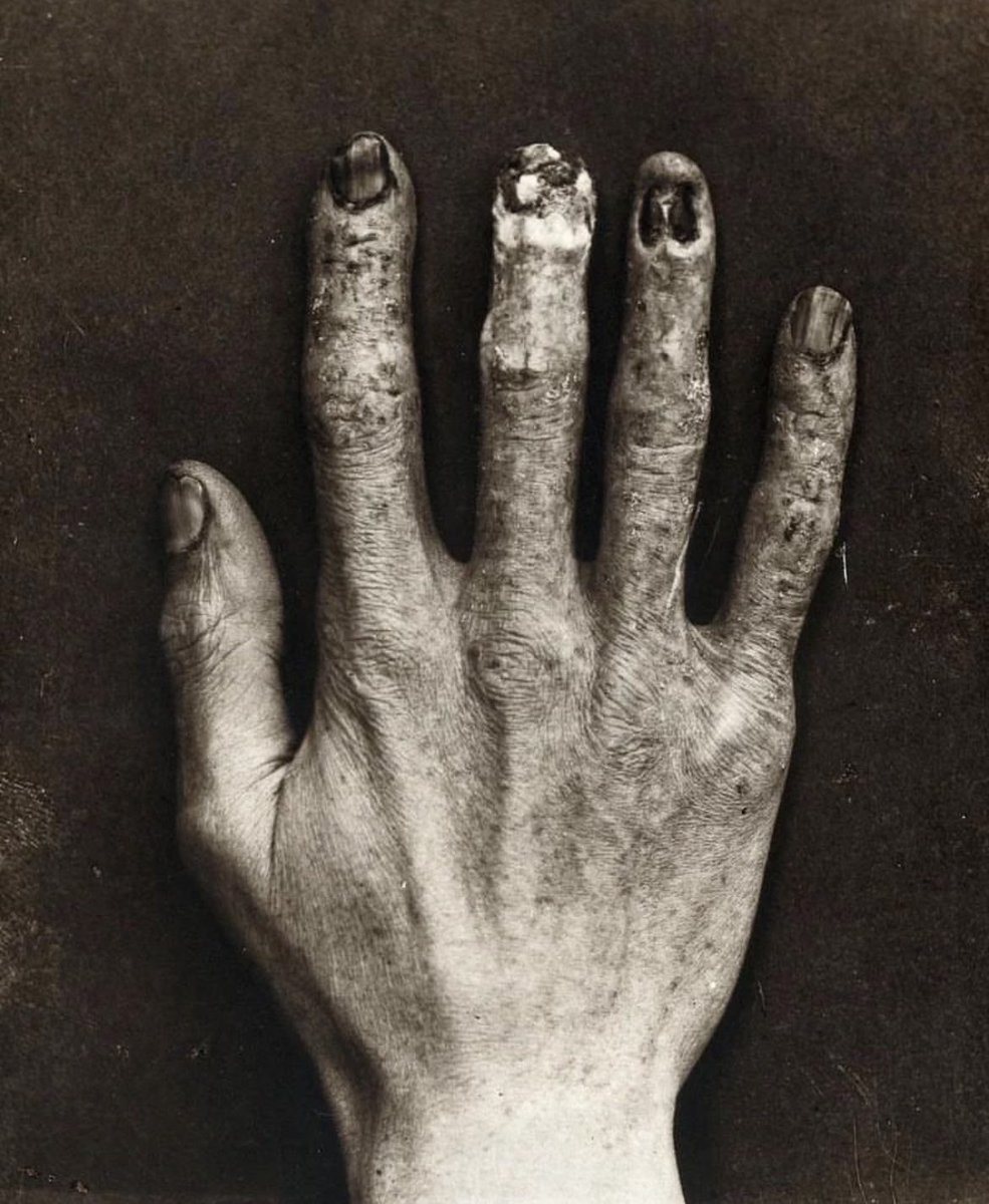 Hand belonging to an X-ray technician at the Royal London Hospital, which shows the damage from radiation exposure, 1900.