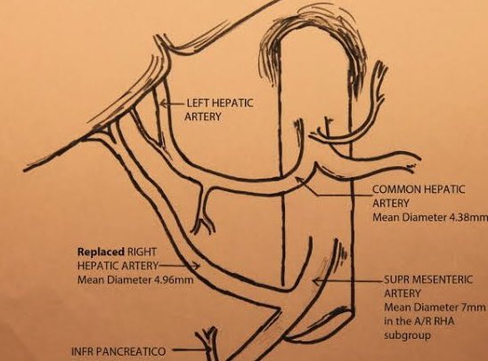 Total #Mesopancreas Excision for #PancreaticHeadCancer #whipple with replace right hepatic artery  Variation in hepatic arterial anatomy is seen in 40-45% of people. we do what we know best. #surgery @hpb_so @IHPBA #liversurgery   #SoMe4HPB #HPB #Hpbsurgery #GISurgery #EAHPBA