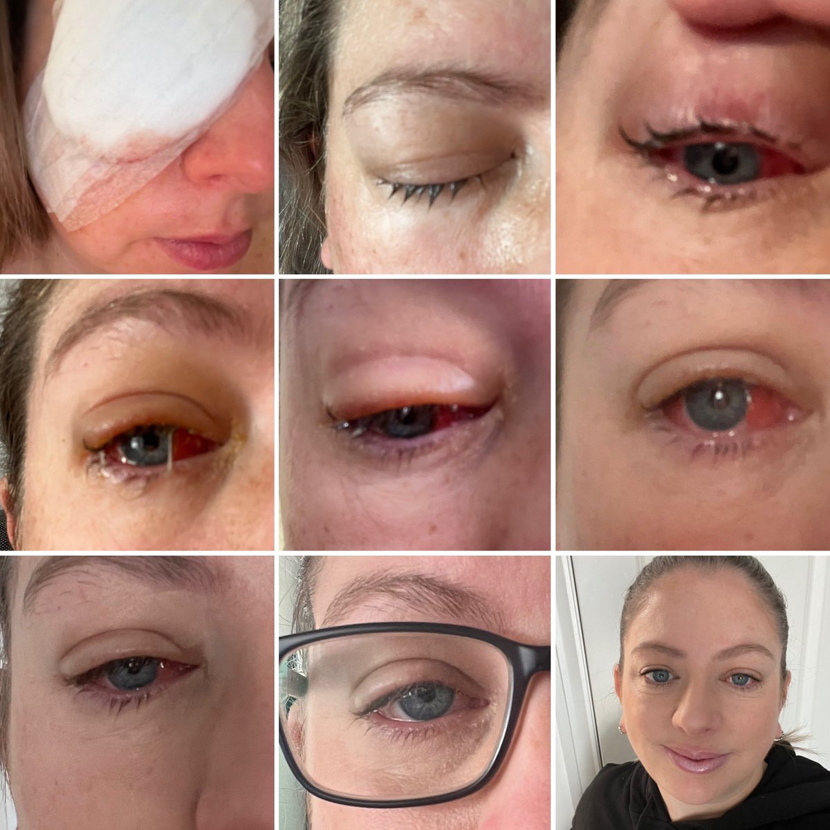 PUNCchelle's tweet photo. I was the patient 6 weeks ago. My right eye has been turning out more over the last 7 years, giving me awful migraines. I had squint surgery aged 2, fast forward 39 years, I had it done again. Pred eye drops are as vile as the tablets FYI! #ThankYouNHS #NotAFanOfBeingAPatient https://t.co/x5sXNqUJd5