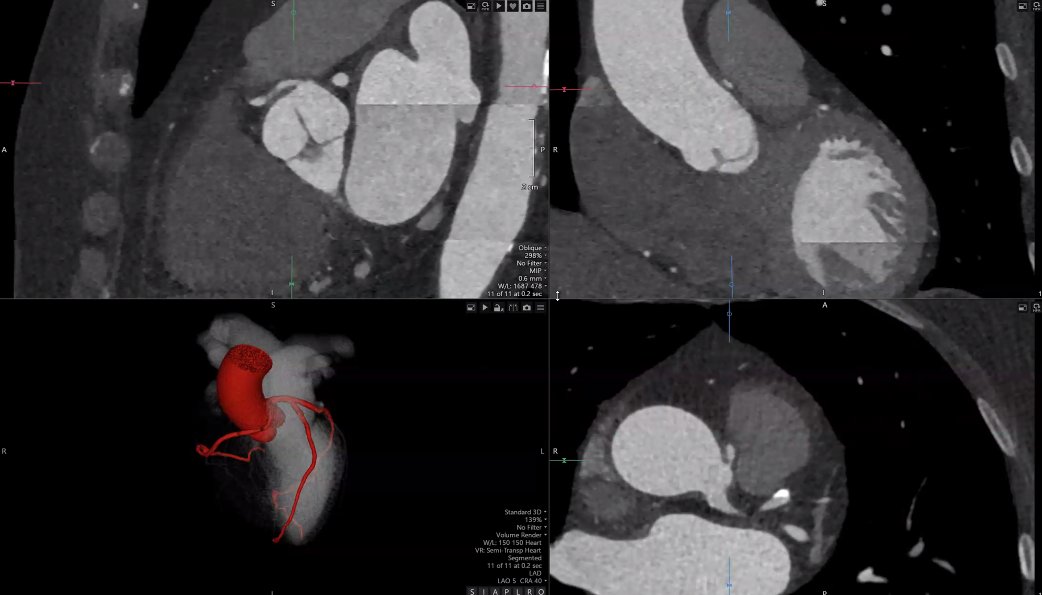 Happening now: @Heart_SCCT RWTE live from @BWHCVImaging program.... Join us as we walk thorough our approach to CCTA, plaque quantification, FFRct, anomalous coronary arteries, and more.... @BrunoLimaMDPhD @AnamWaheed05 @RCardoso_MD @msteigner