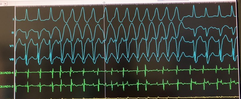 #EPeeps what do you see here? Quad is in the tricuspid annulus #arrhythmia #cardiology #traces #catheterablation