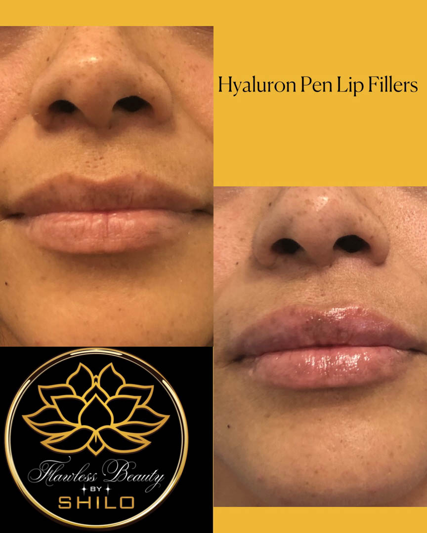 If you want to learn more about our Hyaluron Pen Filler services, be sure to make your way over to our website! We look forward to hearing from you soon! #HyaluronPenFiller bit.ly/3Q9DrWK