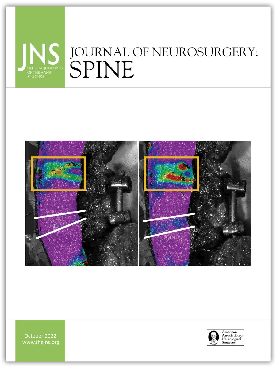 The cover of the October issue of <a href="/TheJNS/">Journal of Neurosurgery</a>: #Spine features an image from our manuscript, "Subtle segmental angle changes of single-level #lumbarfusions and adjacent-level #biomechanics: cadaveric study of optically measured disc strain." Read it here: bar.rw/3VUk5ca