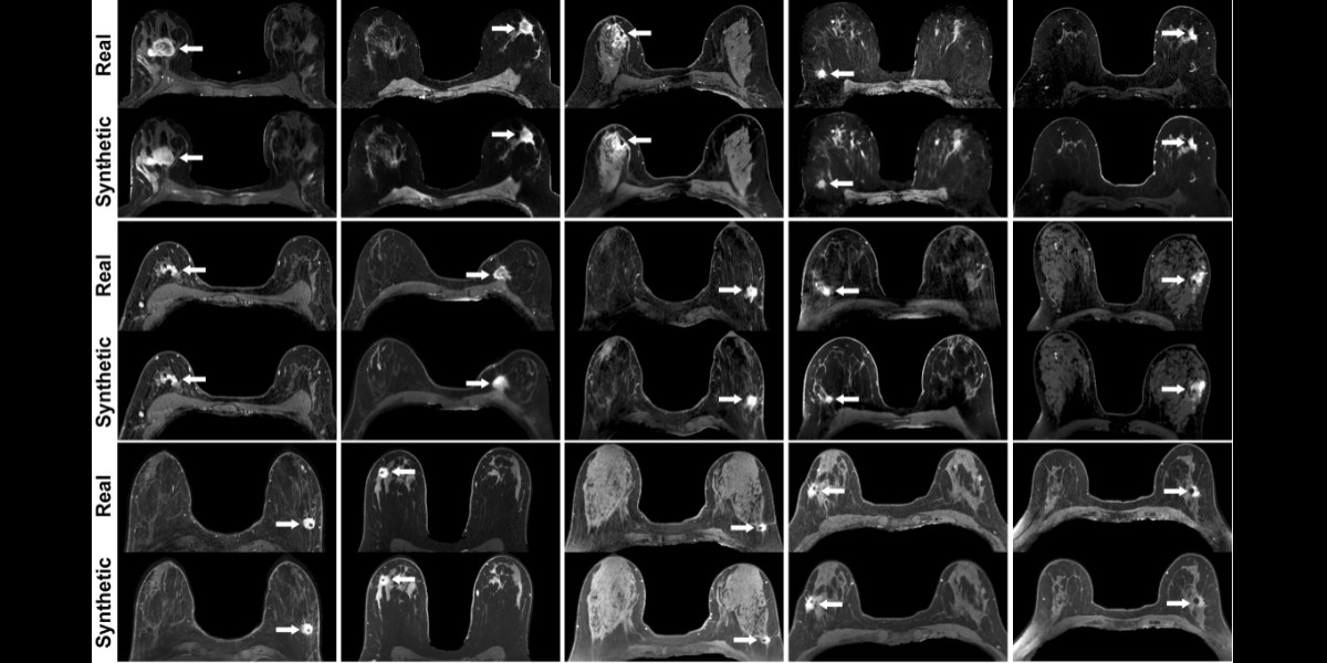 'Our results found that it is feasible to generate simulated contrast-enhanced #breastMRI using #DeepLearning,' says Dr. Maggie Chung, @UCSFImaging fellow. The @UCSF_ci2 team is looking forward to the release of the published paper. bit.ly/3C5vvAY