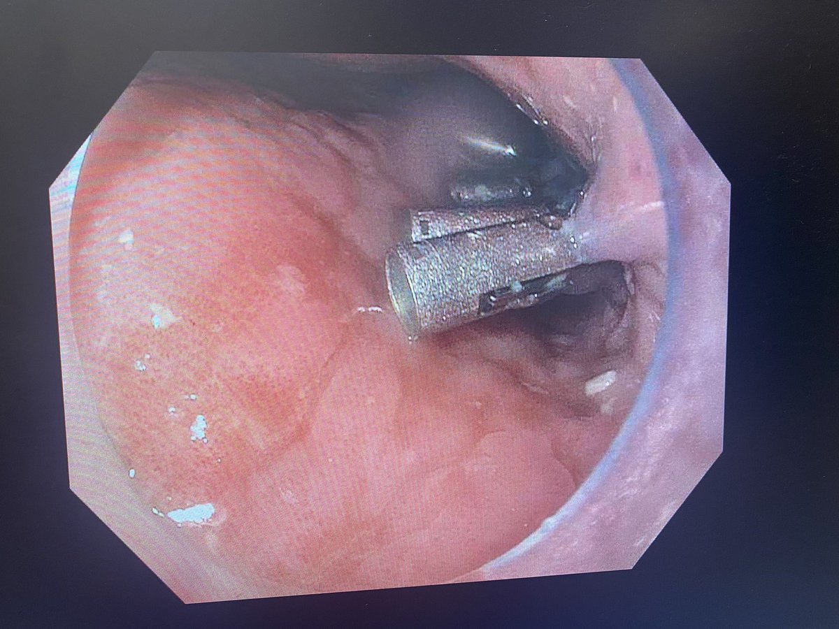 A very exciting day for us at SUNY Upstate Medical University, with the formal start of our Third Space Endoscopy Program, I performed first Esophageal POEM at Upstate. Special thanks to my teachers/mentors @DennisYangMD and @DrHasan_Orlando for excellent training at CIE.