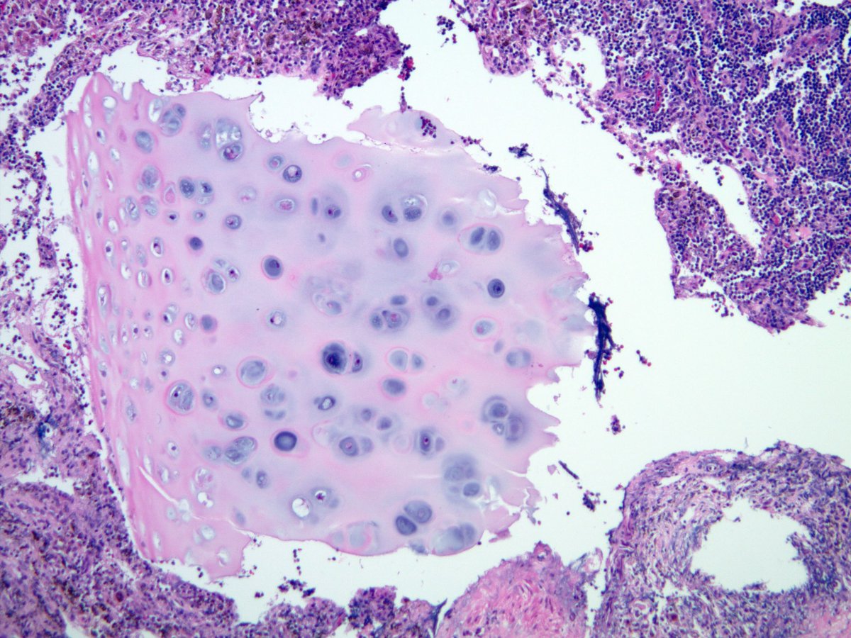 smlungpathguy's tweet photo. Yes, there was a prior EBUS-TBNA in this lymph node (4R)

#laraslesion #ebustwitter #pathology #cytopath 

https://t.co/jL5l2oftyk https://t.co/8z7WEbRnSG