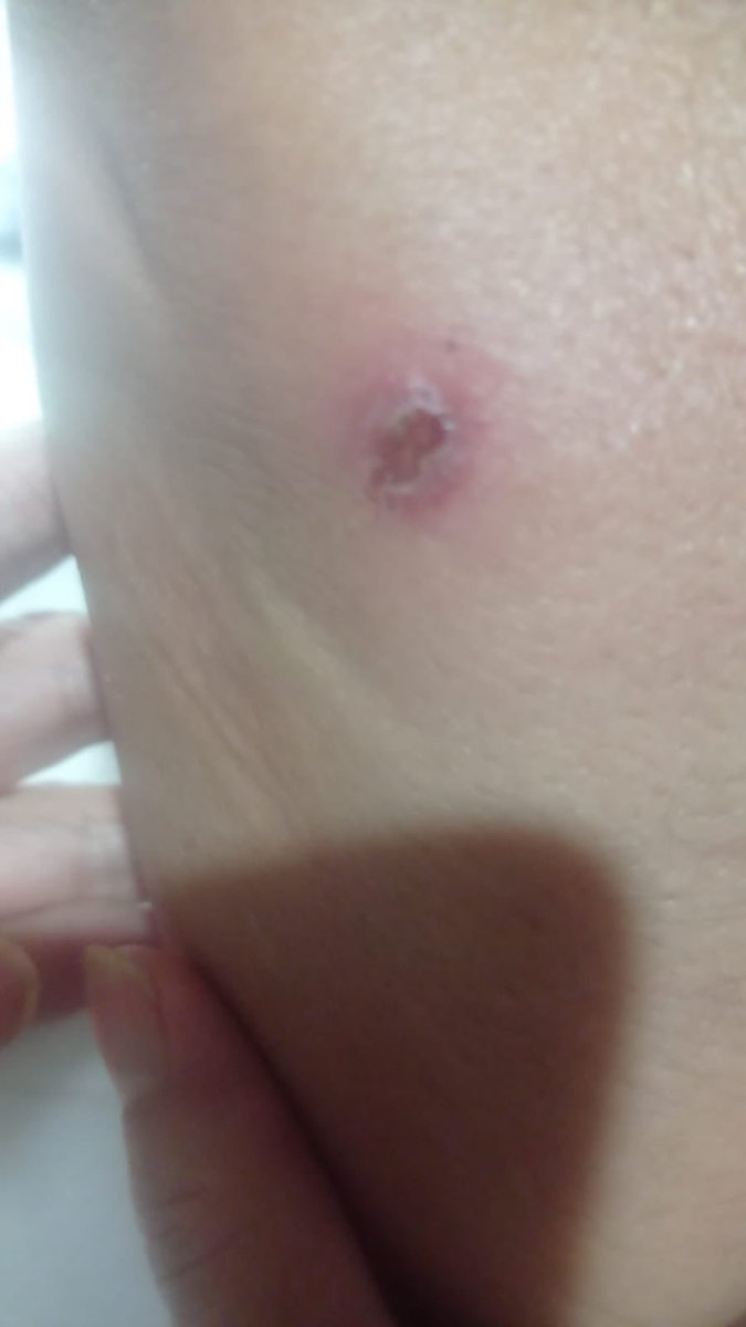 rossjl3's tweet photo. @Arachno_Cosas Hola! Una pregunta, a mi hermana le pico algo pero no tiene ni idea de que fue, crees que nos puedas indicar si es de importancia médica y que fue lo que la picó? https://t.co/Q7z5Hi681M