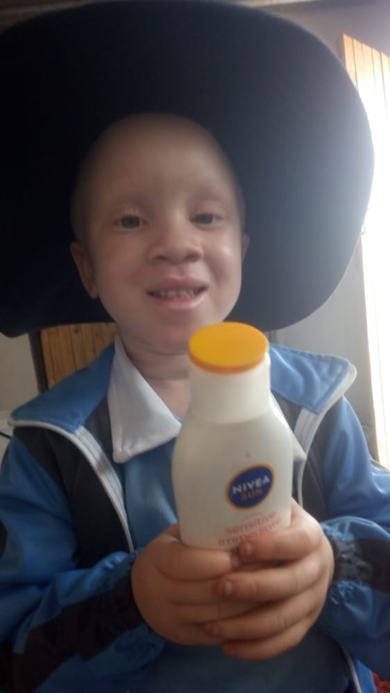 Albinism Network Zimbabwe (@albinismconnect) on Twitter photo 