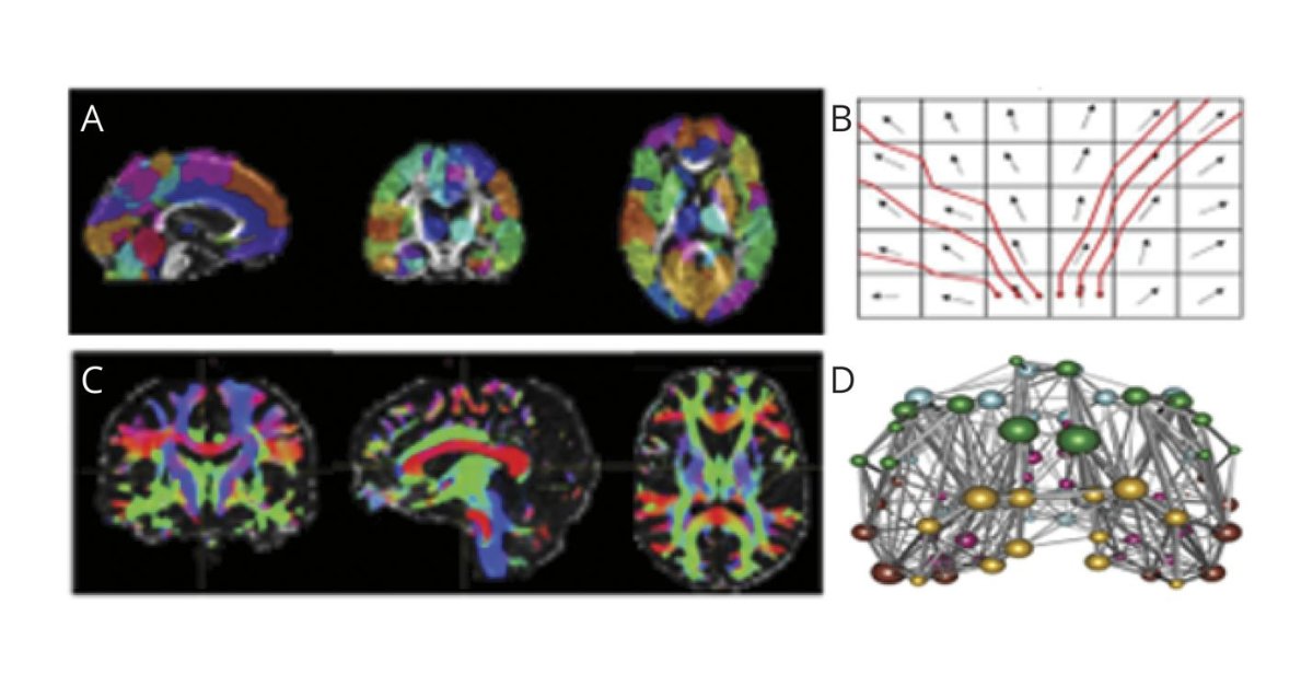 This study provides Class II evidence that intensive blood pressure lowering in patients with small vessel disease results in improved brain network function when assessed by DTI-based brain network metrics. Read the article: bit.ly/3st8NhH #NeuroTwitter #Neurology
