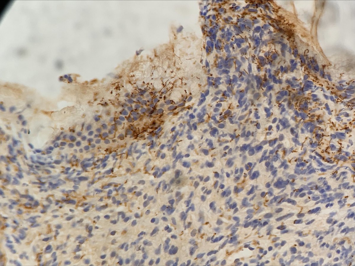 My fist case of Gastric syphilis 
How often do you find ? #GIpath