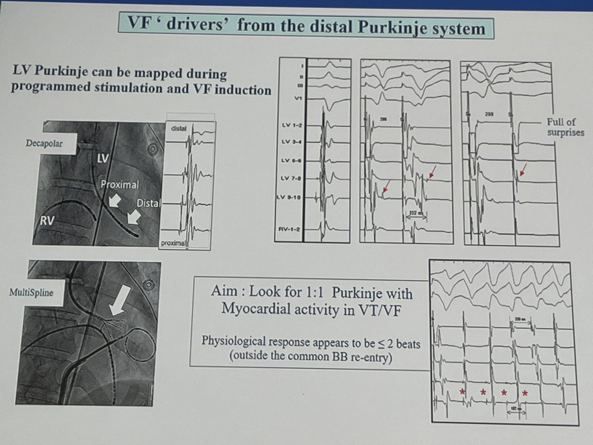 AviSabbag's tweet photo. A fantastic talk by prop Haissaguerre on Purkinje reentry at the #ISCAT2022. Always blows my mind. https://t.co/6Xow4N2xvG