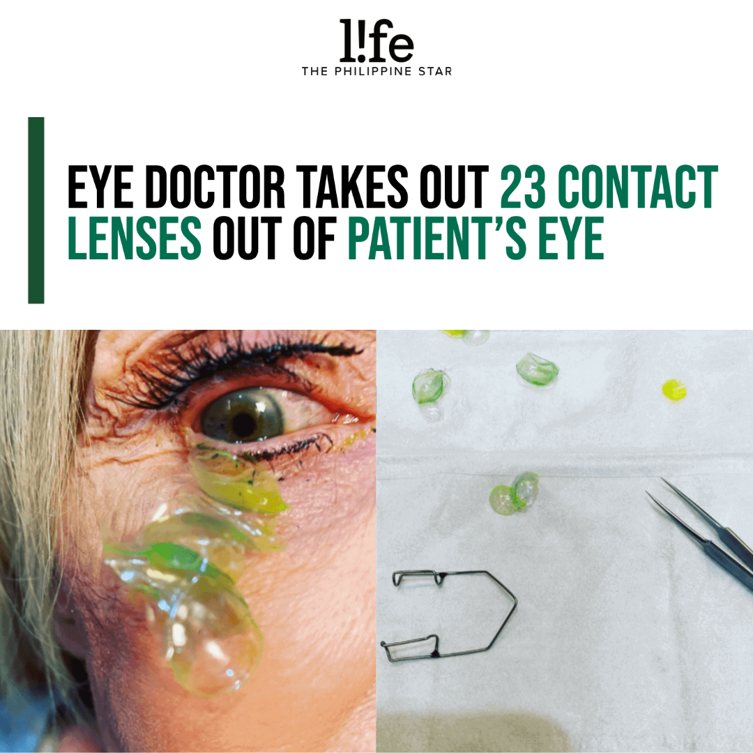 PhilSTAR L!fe on Twitter "A doctor from California had to remove 23