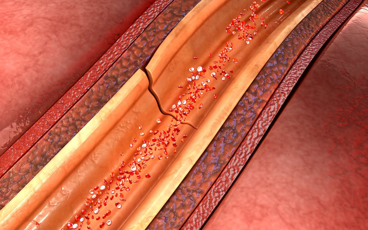 SCAD: challenging, under-recognised form of heart attack … Dr @drbarbmurphy et al write #freeaccess in InSight+ … 'SCAD is an increasingly recognised cause of ACS and sudden cardiac death in people without classic cardiac risk factors' ... insightplus.mja.com.au/2022/40/scad-c… #medtwitter