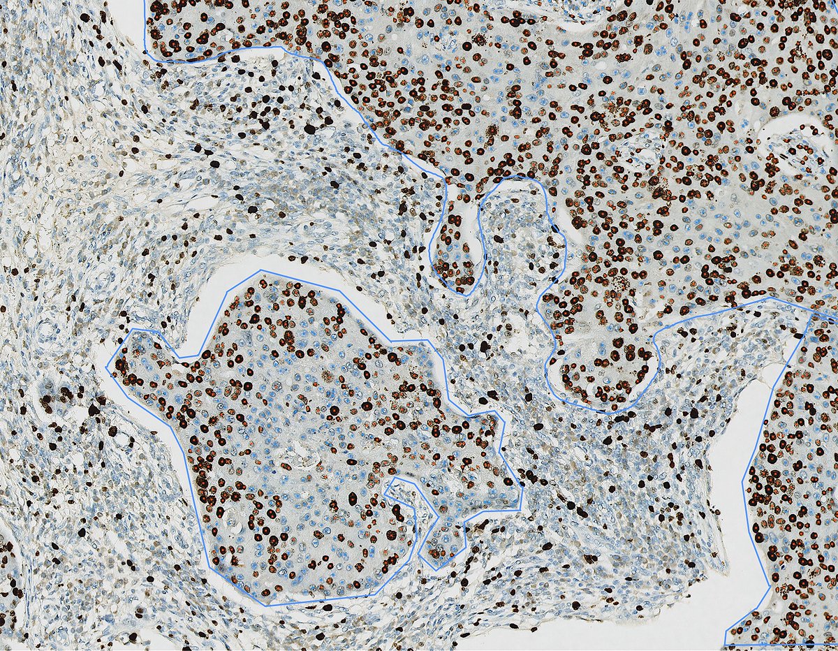 aetherAI_tw's tweet image. #breastcancer aetherAI IHC specifically automates, expedites, and standardizes the measurement of IHC results. It fully integrates with #pathology workflow, increasing measurement consistency in various clinical scenarios, and shortening the review time. buff.ly/3fZIGfc