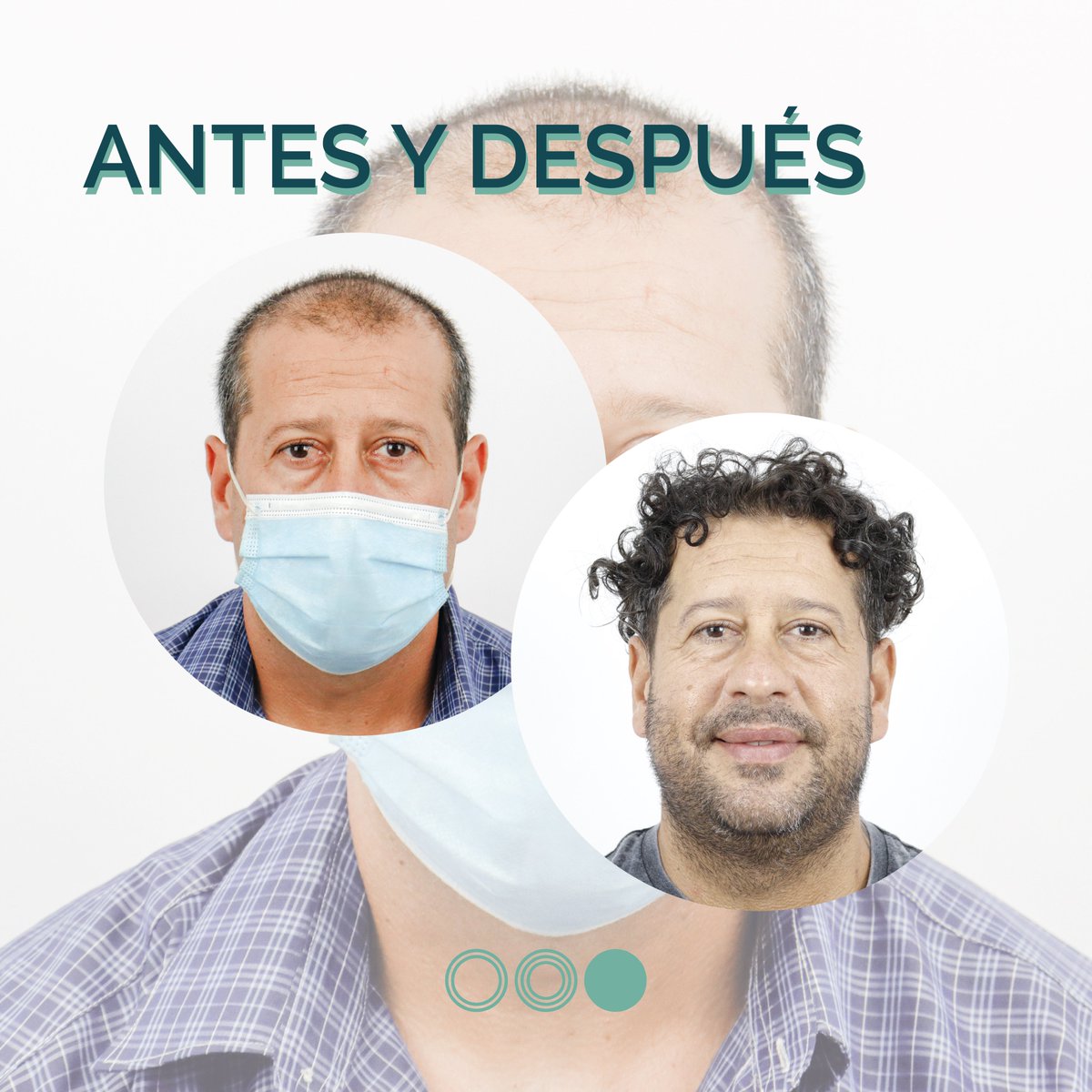 Hoy os traemos este antes y después en el que podéis ver la evolución desde antes del injerto capilar hasta cumplirse un año desde la cirugía 🤩

¡Únete a la #RevoluciónCapilar !

#HAIRrevolution #hospitalcapilar #injertocapilar #microinjertocapilar #solucionescapilares