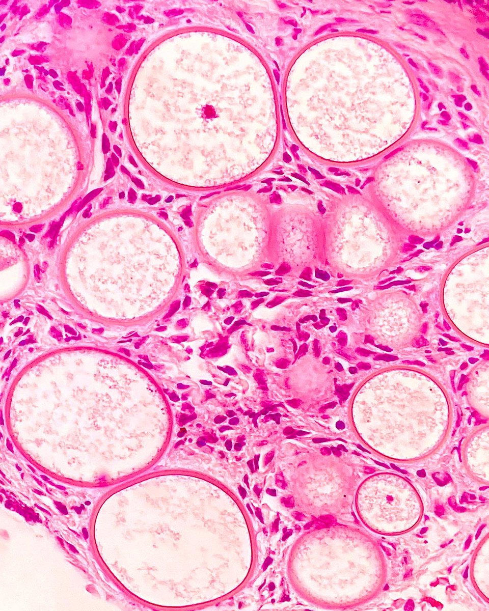 ClevesMario's tweet image. Rhinosporidiosis.

#medicine #anatomy #medschool #pathology #histology #medlife #histologia #path #pathologists #oncology