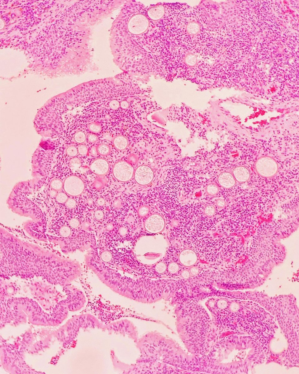 ClevesMario's tweet image. Rhinosporidiosis.

#medicine #anatomy #medschool #pathology #histology #medlife #histologia #path #pathologists #oncology