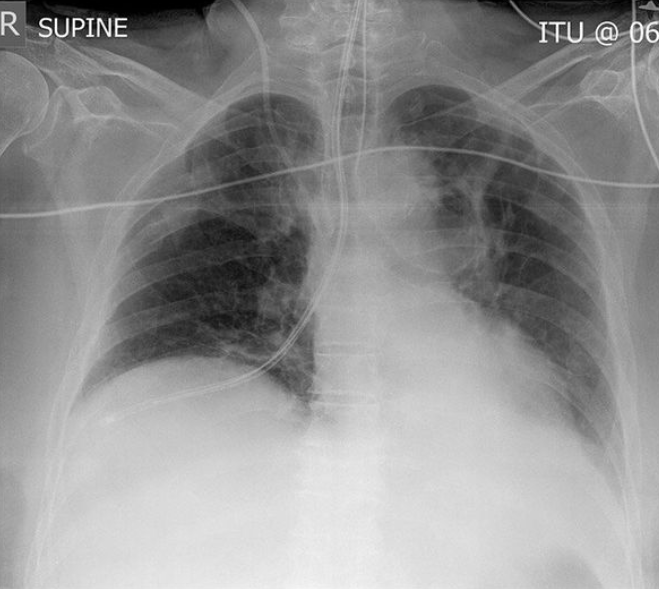 CHEST X-RAY QUIZ 1 - # 8 Which statement is correct? A - X-ray is of poor quality and should be repeated B - ET tube should be advanced C - Internal jugular line should be removed D - NG tube should be removed E - Lungs are normal START QUIZ goo.gl/jx6ezW
