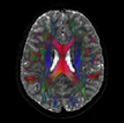 "An analysis-ready and quality controlled resource for pediatric brain white-matter research"

nature.com/articles/s4159…

Very happy to have contributed to this article within The Fibre Community Science Consortium!