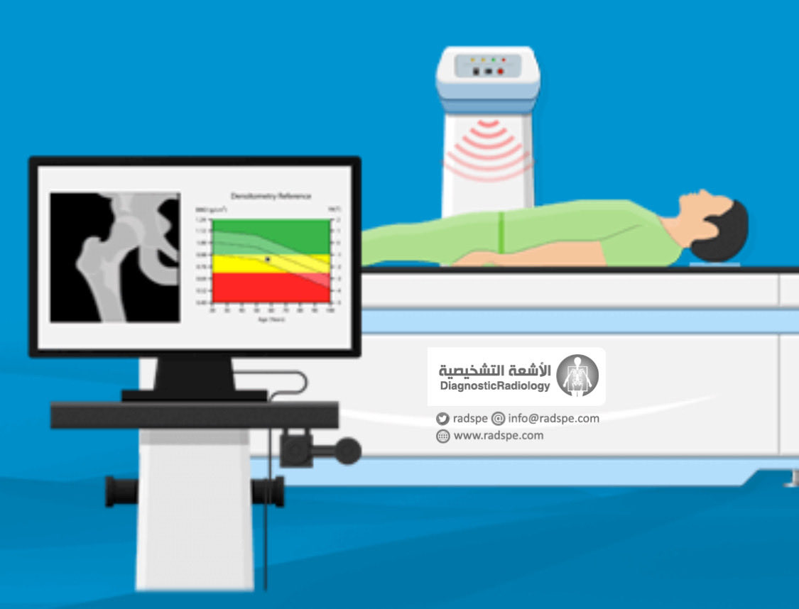 radspe's tweet image. ثريد | Thread
#الأشعة_التشخيصية 

ماهو فحص BMD ؟
Bone mineral density

هو اختبار كثافة العظام الذي يحدد ما إذا كنت مصابًا بهشاشة العظام أم لا، وهو اضطراب تكون العظام فيه أكثر هشاشة وأكثر عرضة للكسور. يُستخدم جهاز Dexa Scan في إجراء الفحص
