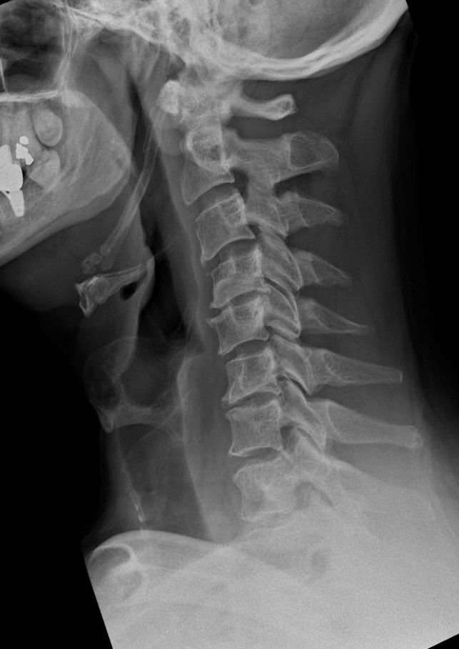 Middle aged chap. Positional neck pain and neurology

The beady-eyed might like to get their claws into this case