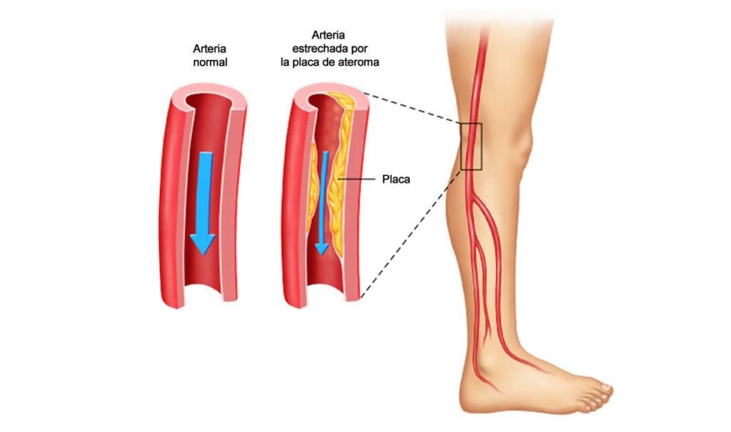 La etiología predominante de la enfermedad oclusiva de las extremidades inferiores es el cambio ateroesclerótico de la íntima y la media arteriales.